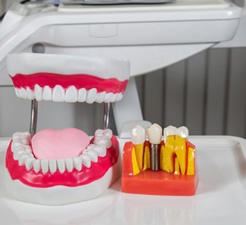 All You Need to Know About Same-Day Dental Crowns