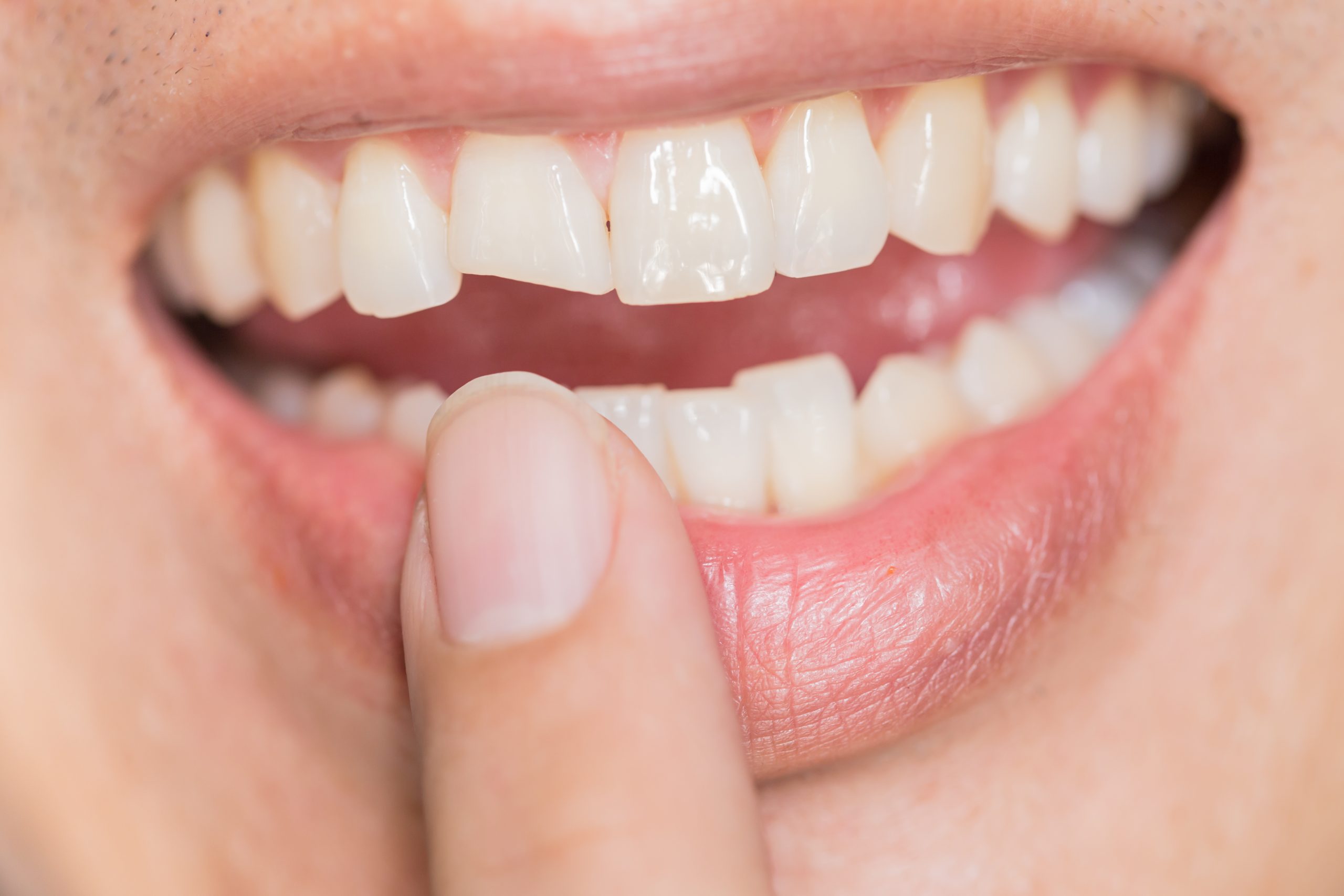 What’s causing my teeth to break?
