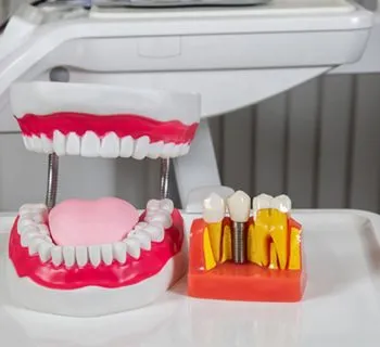 All You Need to Know About Same-Day Dental Crowns in Houston TX