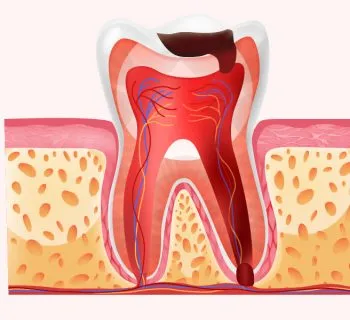 Periodontal Disease and Its Impact on Your Oral Hygiene Routine in Houston TX